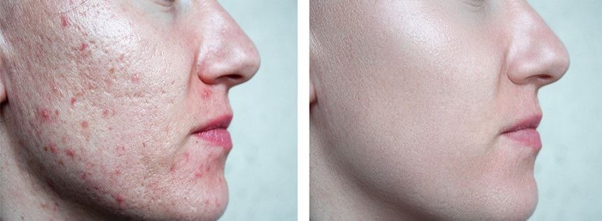 Acne removal before after 2