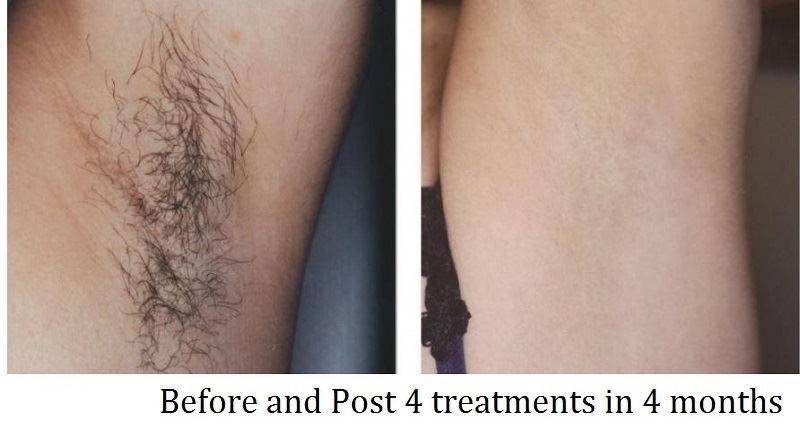 Hair Removal Before After 3