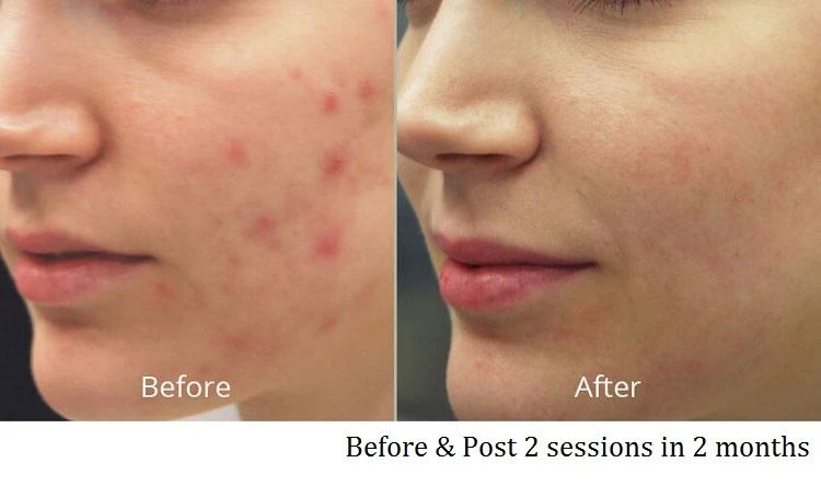 Acne removal before after 1